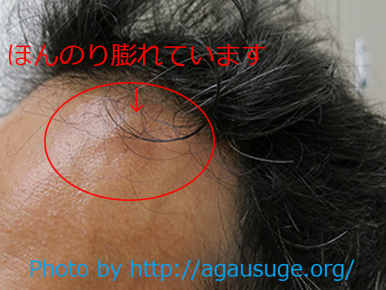 注射で少しプックリ腫れた頭